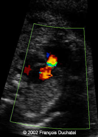 stenose pulm5