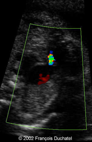 stenose pulm6