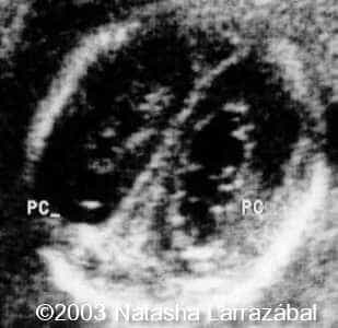 T18 The fetus 4