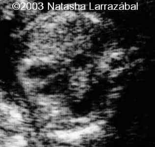 T18 The fetus 6