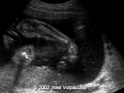 talipes3
