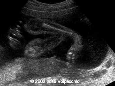talipes4