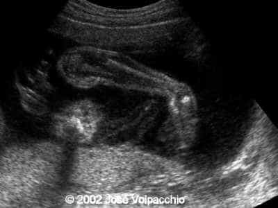 talipes5