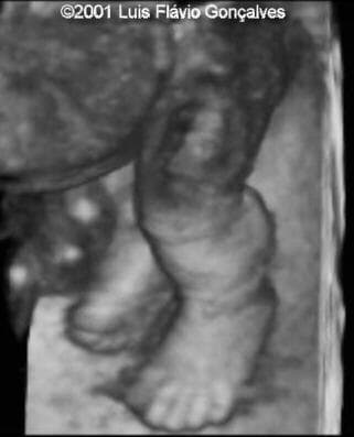tanatoleftleg3d02