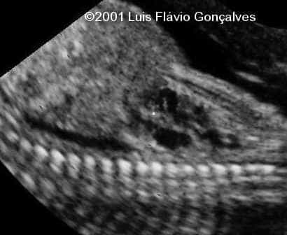 tanatothorax02