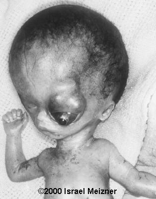 teratoma