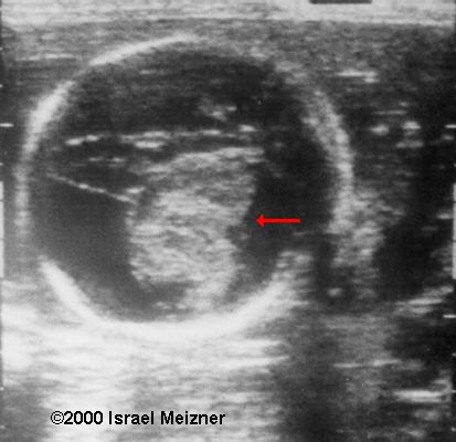 teratoma1