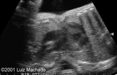 thoraco-2