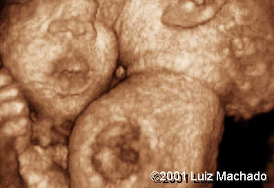 thoraco-3