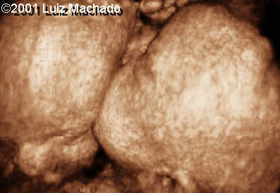 thoraco-4