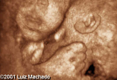thoraco-6