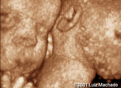 thoraco-8