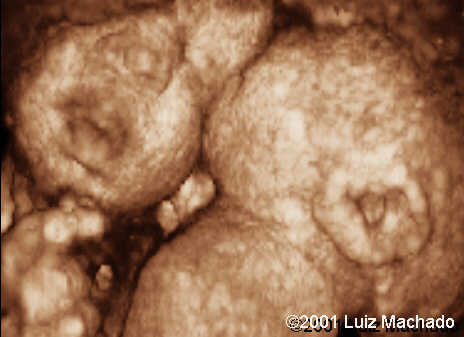 thoraco-9