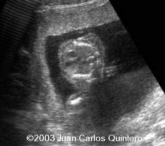 torax 18 weeks