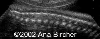 trisomia6