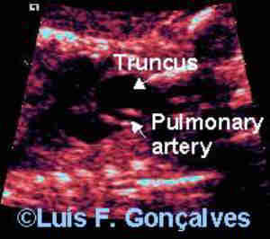 truncus01