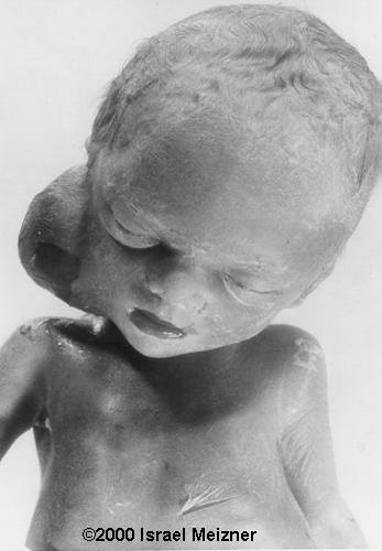 tumors_of_skin_meizner-2