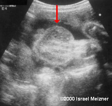 tumors_of_the_extremities_meizner-1
