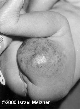 tumors_of_the_extremities_meizner-3
