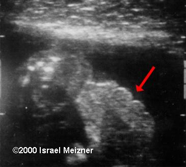 tumors_of_the_extremities_meizner-4
