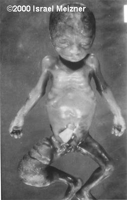 Tumors_of_the_extremities_Meizner-5