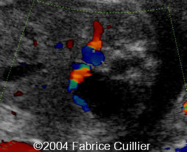 ureterocele1