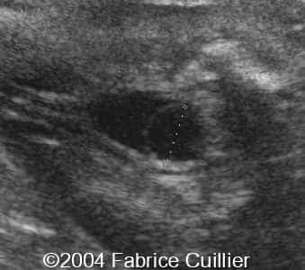 ureterocele2