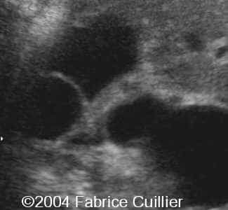 ureterocele3