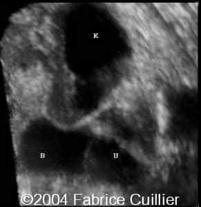 ureterocele5