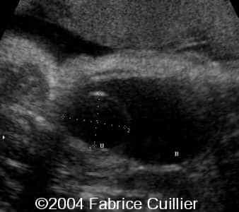 ureterocele6