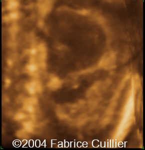 ureterocele7
