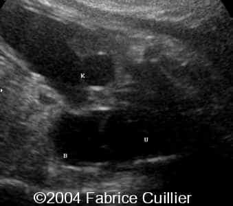 ureterocele8