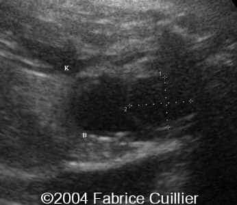 ureterocele9