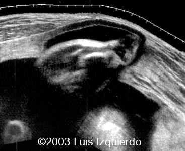 uterinedehiscence