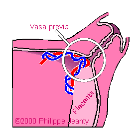 vasa_p2