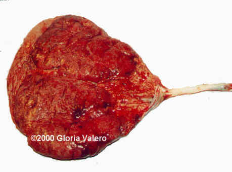 vasa_previa3_4