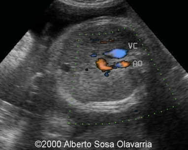vena cava ant y ao