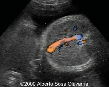 vena umbilical en vena cava