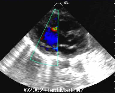 VSD NEONATAL